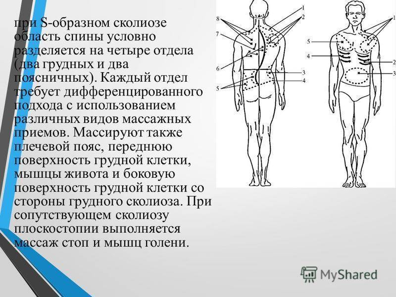 Гимнастика, лфк и комплекс лечебных упражнений при сколиозе