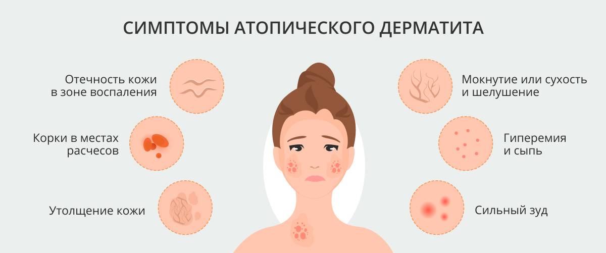 Острые аллергические реакции у детей: симптомы, лечение и профилактика