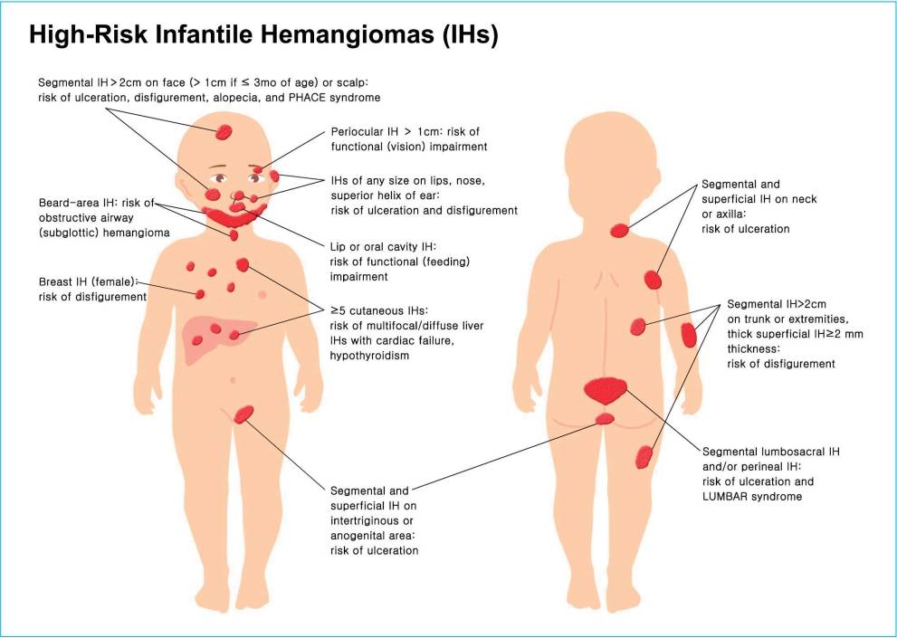 Гемангиома у новорожденных детей: виды гемангиом, причины и лечение