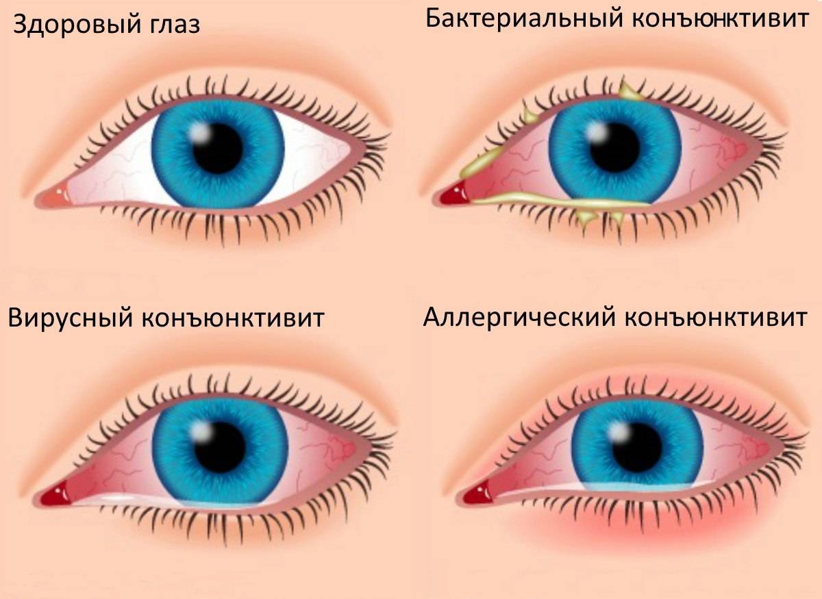 Вирусный конъюнктивит у детей - симптомы болезни, профилактика и лечение вирусного конъюнктивита у детей, причины заболевания и его диагностика на eurolab