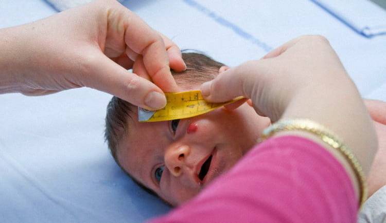 Гемангиома у новорожденных: топ методов лечения и профилактики