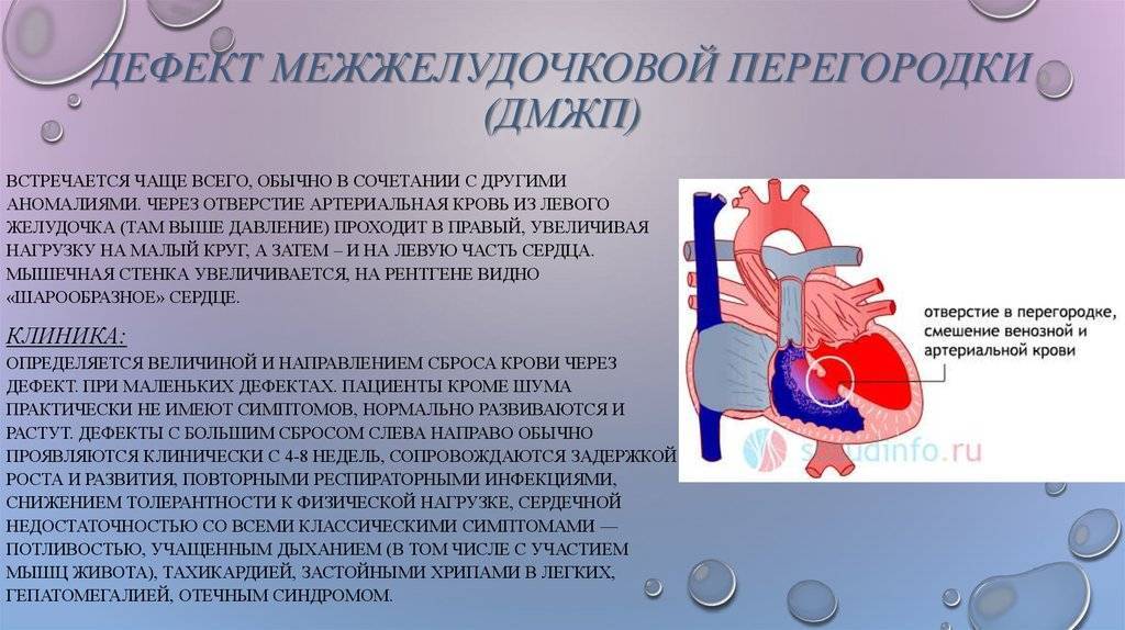 Впс дмжп у новорожденного