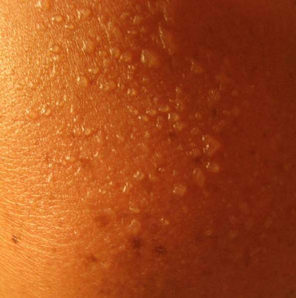 У ребенка сыпь на спине и животе: фото с пояснениями видов аллергии