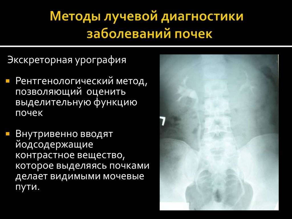 Врожденные аномалии почек, причины | genetyka.com.ua