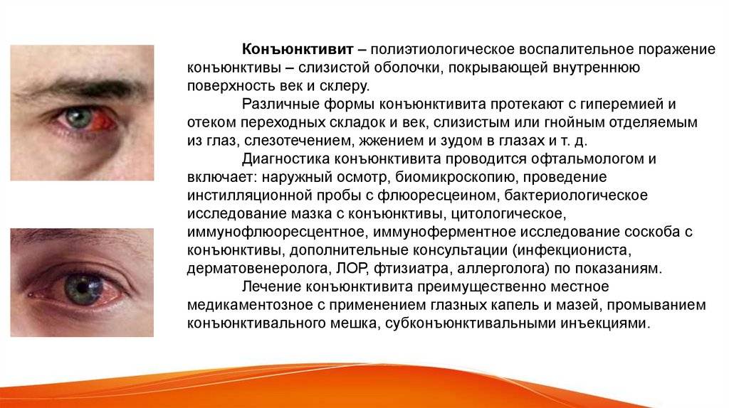 Лечение и симптомы вирусного коньюктивита у взрослых и детей - как вылечить быстро