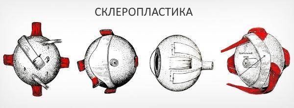 Склеропластика глаз: что это такое, за и против, особенности операции у детей, отзывы