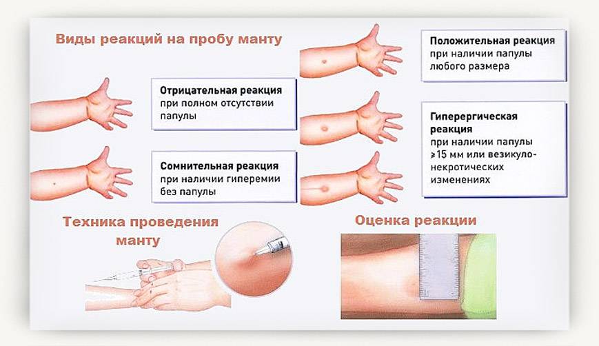 Проба манту: оценка результата у детей