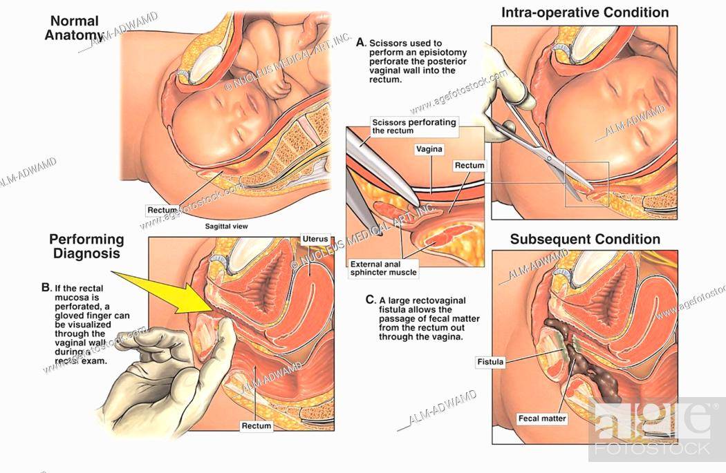 Влагалище после родов, восстановление органа у рожавшей женщины