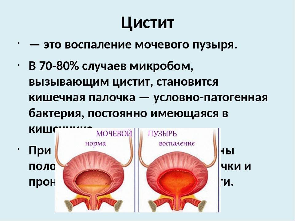 Цистит у детей разных возрастов - "наша радость"