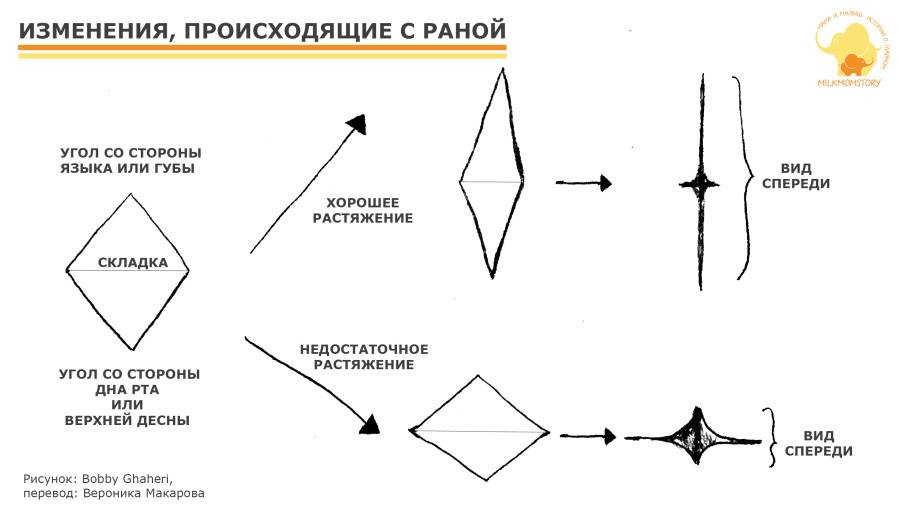 Какой врач подрезает уздечку языка ребенку