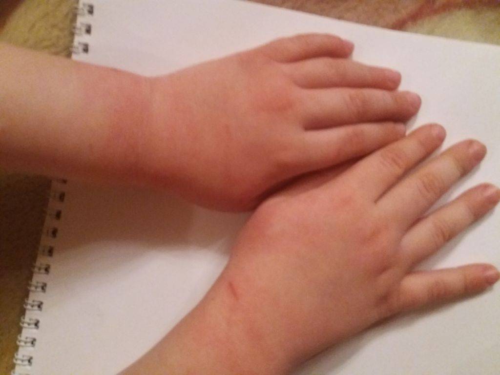 Шелушится кожа у новорожденного на теле, ногах, руках, голове: причины и лечение | mustela