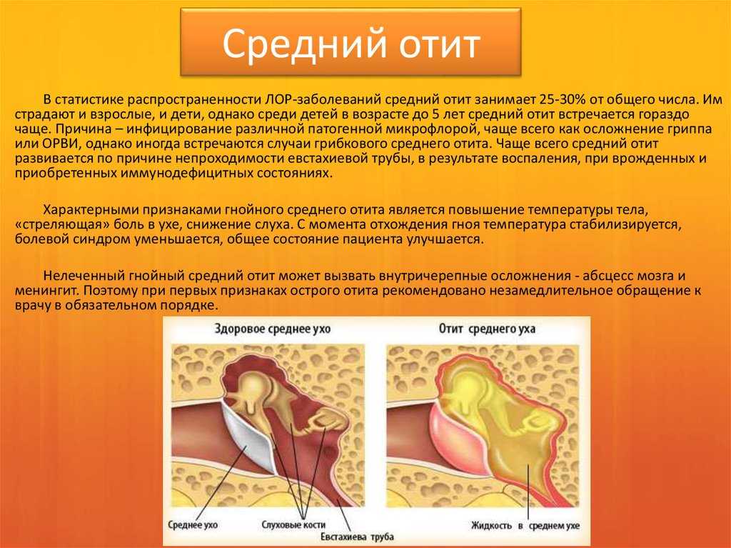 Экссудативный отит: симптомы, причины и методы лечения