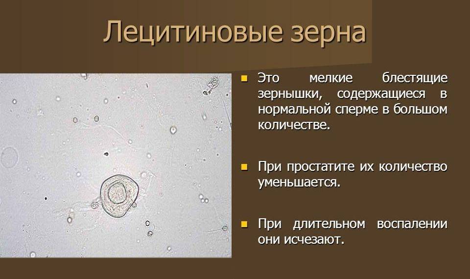 Липоидные тельца в спермограмме, макрофаги, кристаллы спермина и другие объекты в сперме