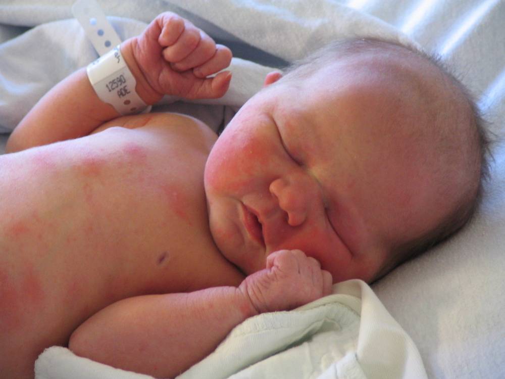 Токсическая эритема новорожденных: симптомы и лечение