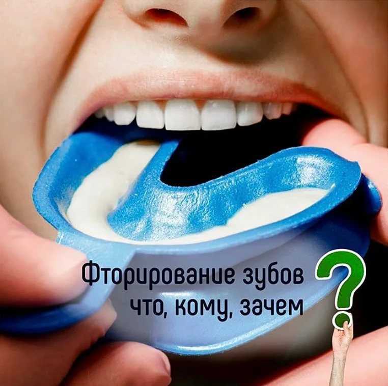 Фторирование зубов: что это такое, фото до и после