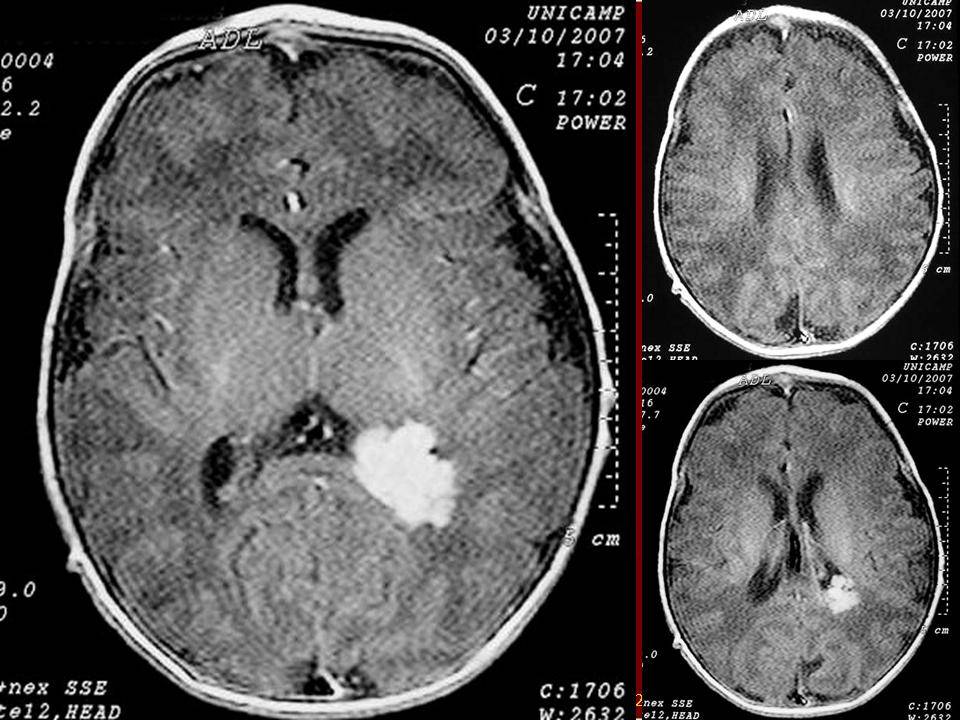 Псевдокиста головного мозга: причины возникновения и лечение