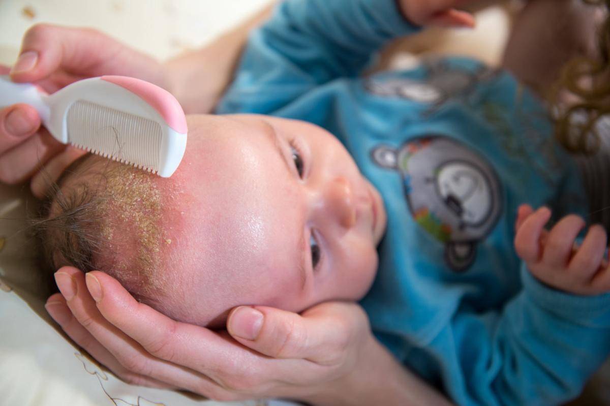 Себорейный дерматит у детей: лечение, фото на голове и лице, как вылечить ребенка 1, 3, 5 лет