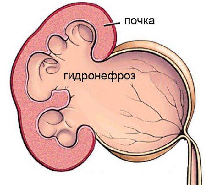 Гидронефроз у детей - причины, симптомы, степени и лечение - prourologia.ru