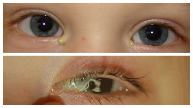 Закисает глаз у ребенка 3 года комаровский. что делать, если у ребенка сильно закисают глаза
