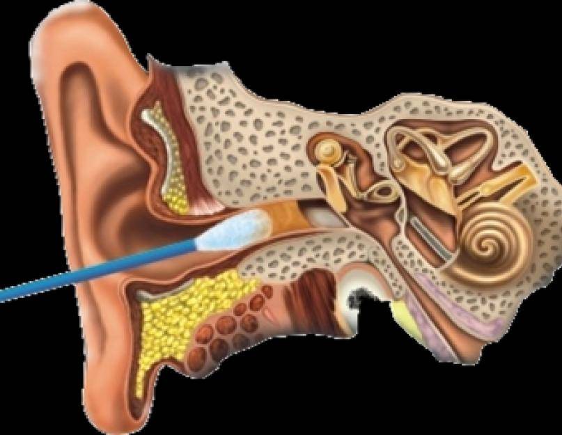 Чем промыть ухо от серной. Ушная сера в барабанной перепонке. Отомикоз серная пробка. Серная пробка на барабанной перепонке. Серная пробка ватные палочки.