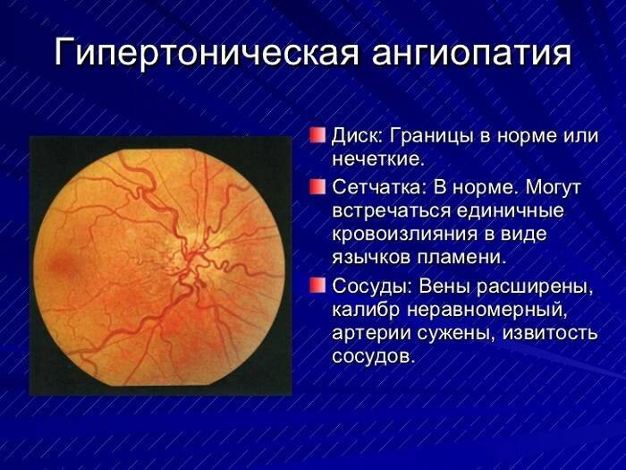 Ангиопатия сосудов сетчатки глаза у ребенка (в т.ч. у новорожденного) - причины и лечение