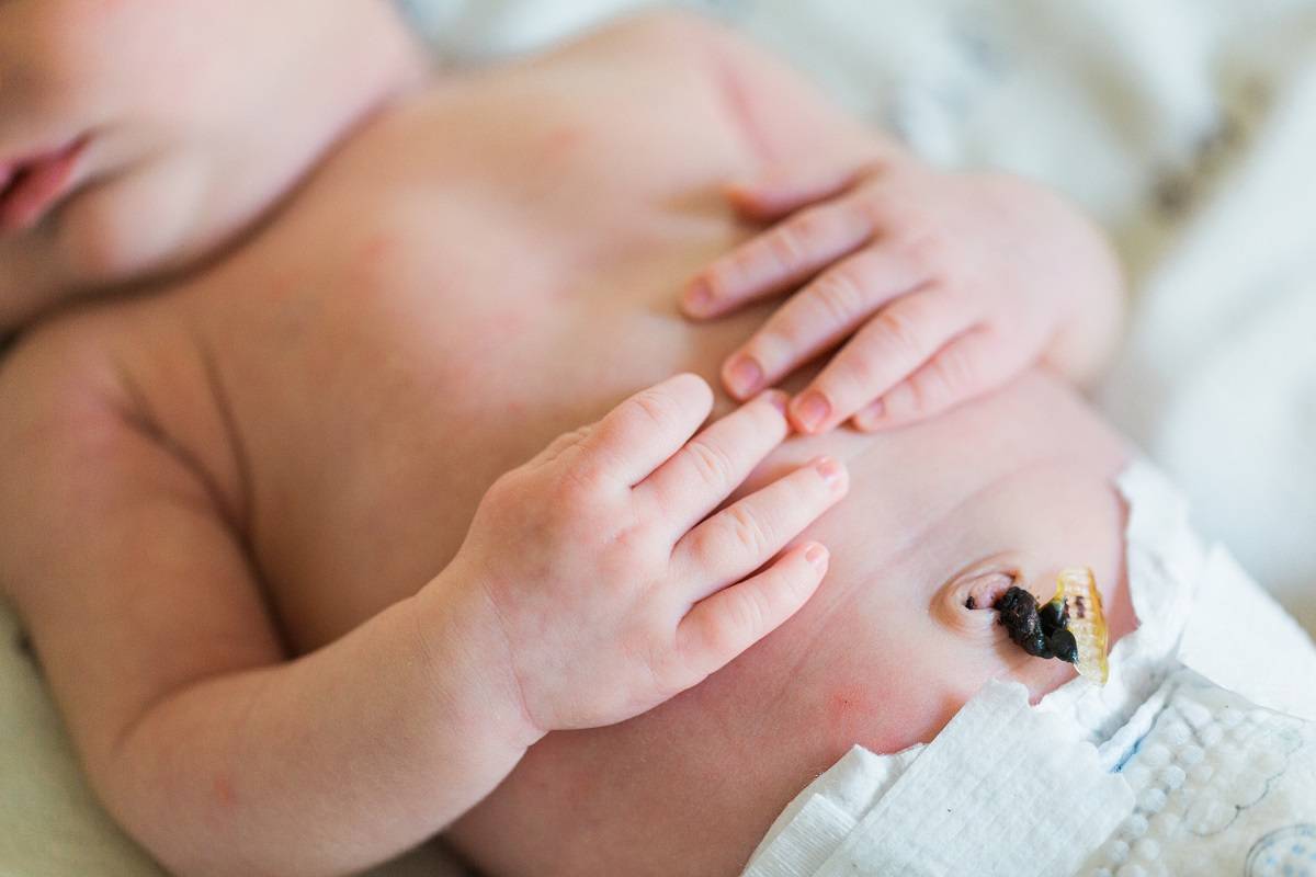 Фунгус пупка у новорожденных: лечение гранулемы, соль и другие средства