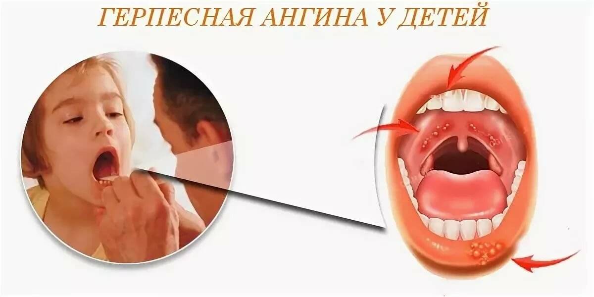 Симптомы, признаки и лечение герпесной ангины у детей