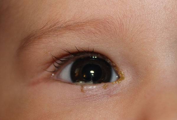 Гноятся глаза у новорожденного: почему и чем лечить