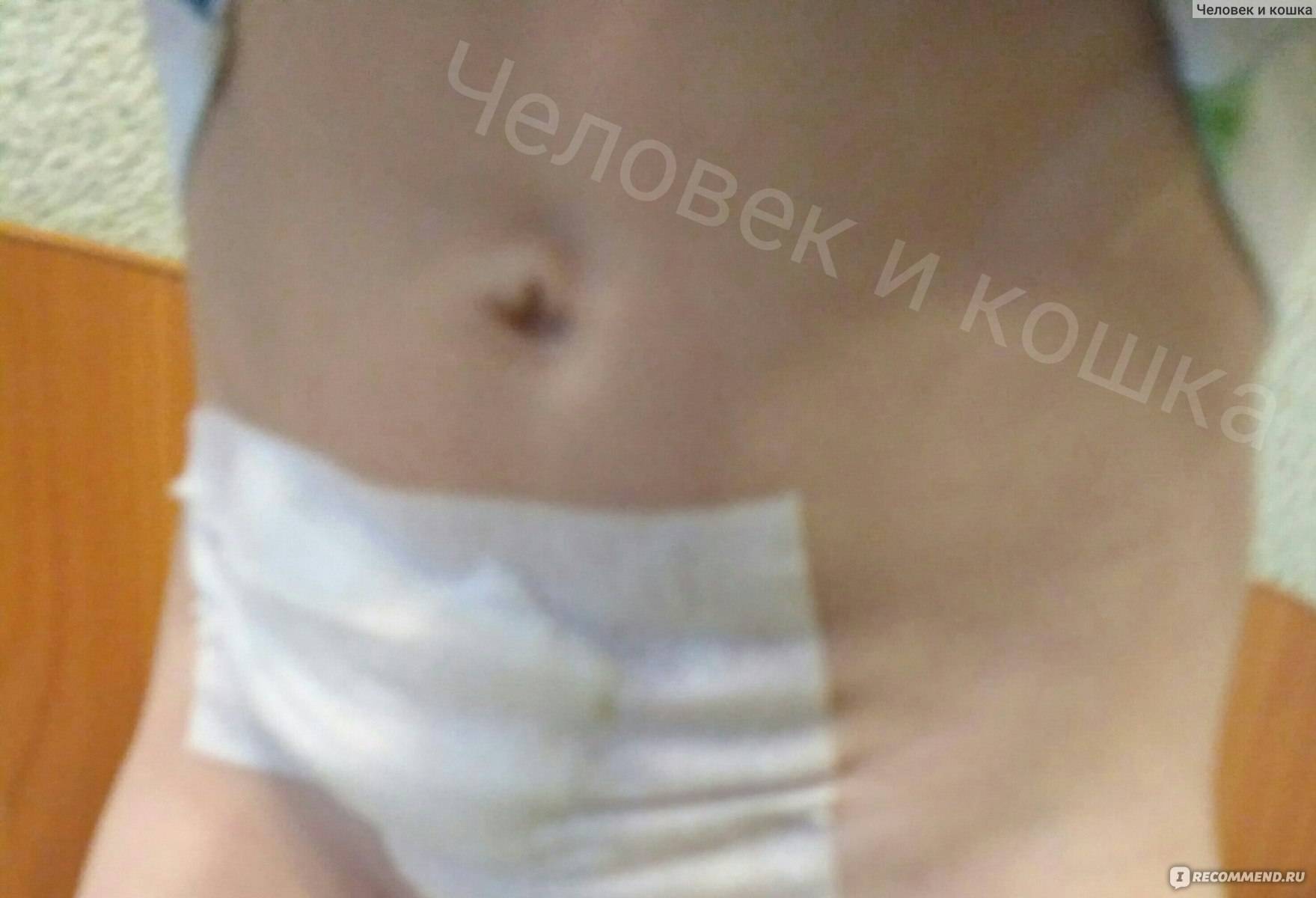 Паховая грыжа у новорожденных детей: фото и лечение мальчиков-грудничков