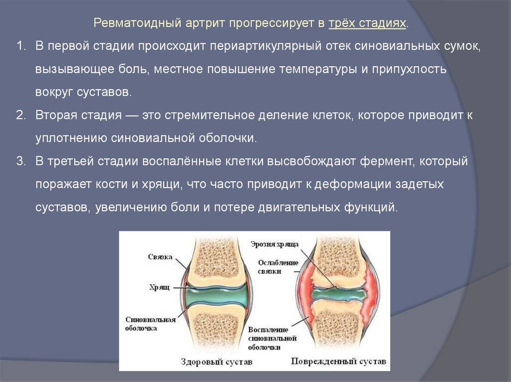 Реактивный артрит коленного сустава у детей: причины, симптомы и лечение