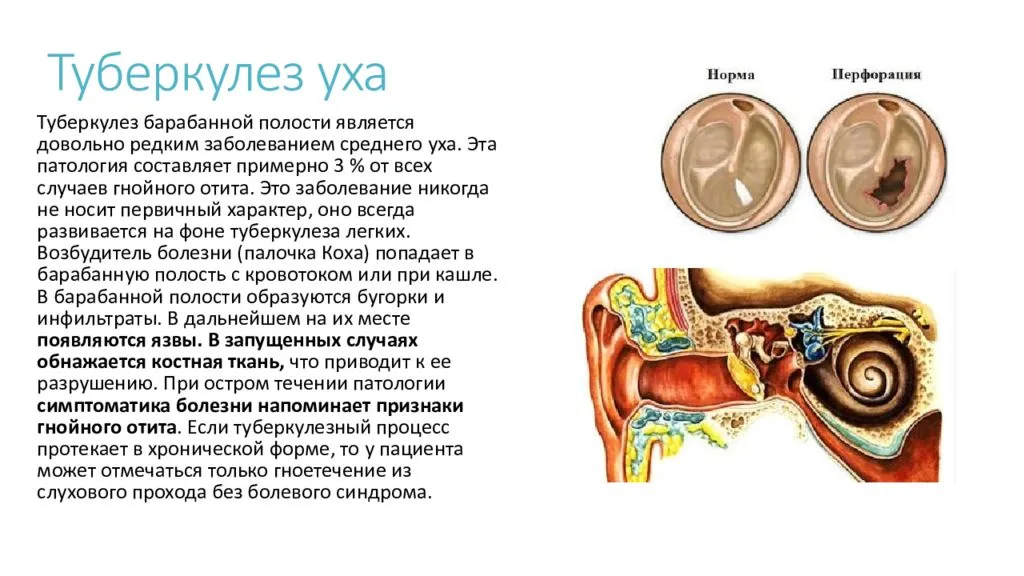 Отит у ребенка