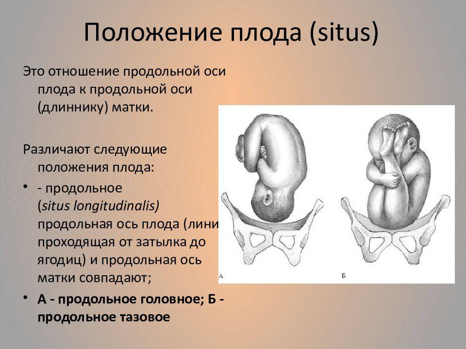 Неправильное положение плода