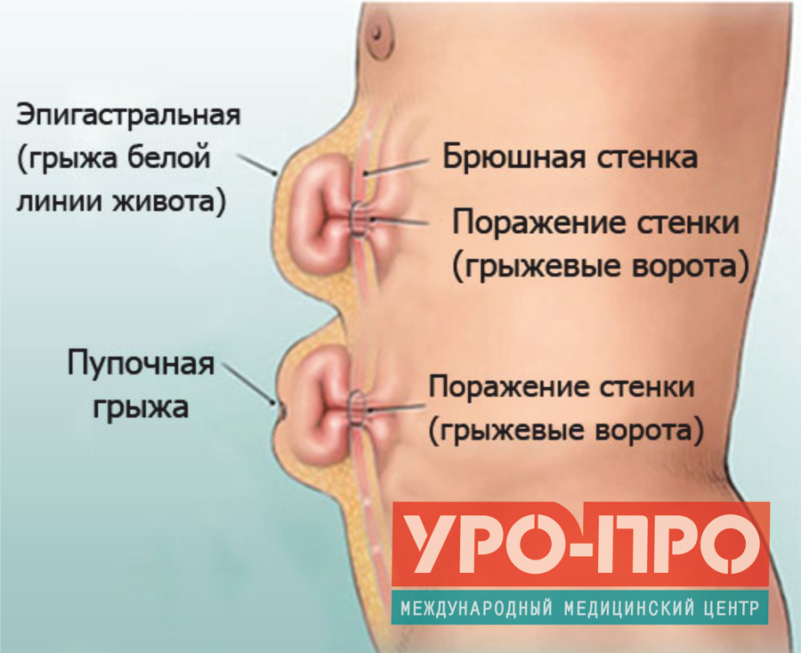 Надпупочная грыжа у новорожденного