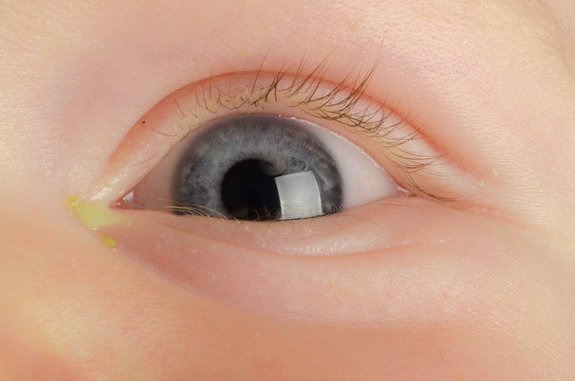 Что делать, когда у ребенка закисают глаза? | визиобуд