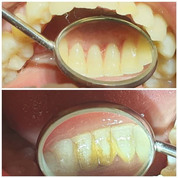 Налет пристли: причины и фото черных зубов у детей в 1-2 года, лечение