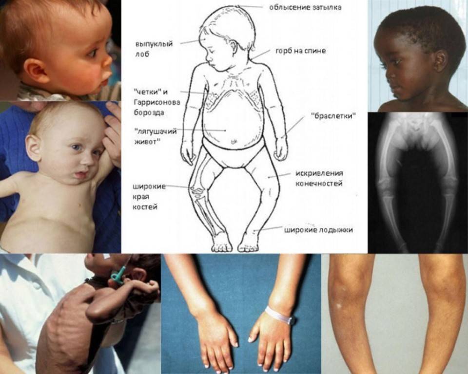 Как определить рахит: симптомы и лечение рахита у детей и грудничков, определение степени и стадии заболевания