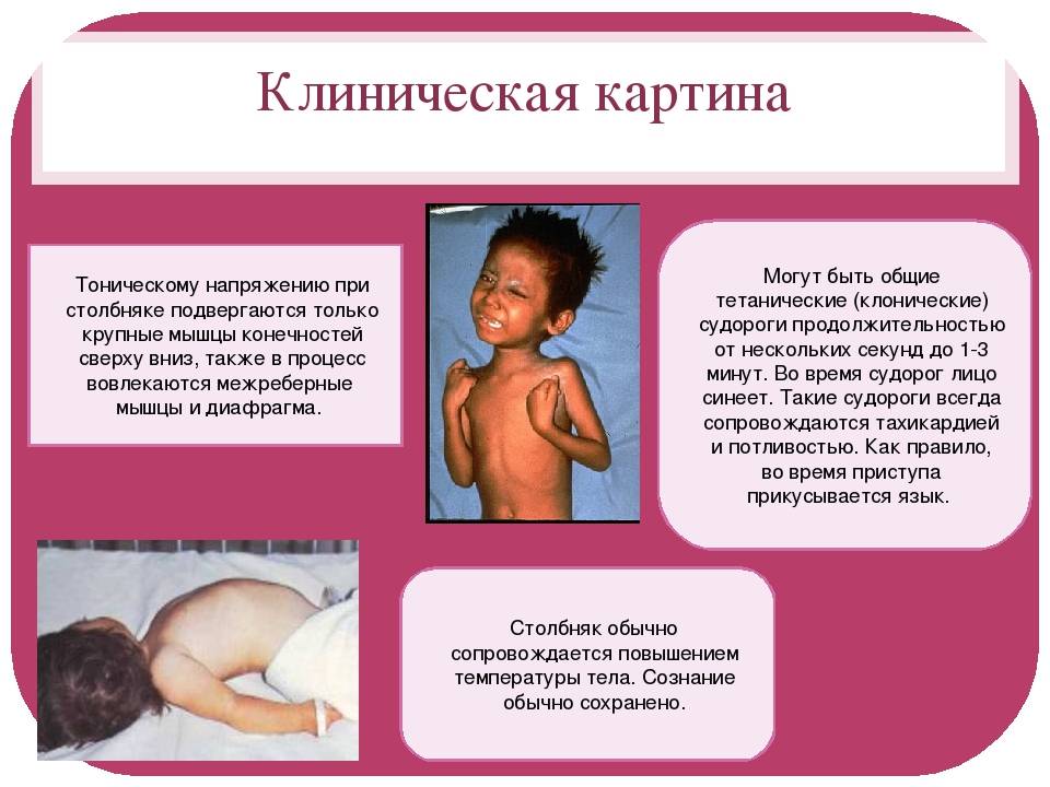 Столбняк у детей - симптомы болезни, профилактика и лечение столбняка у детей, причины заболевания и его диагностика на eurolab