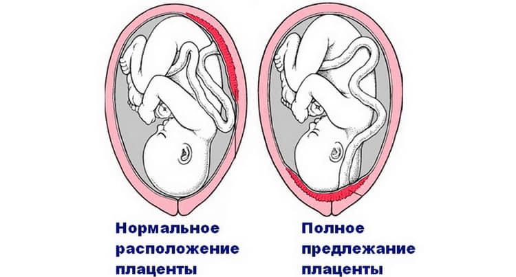 Низкая плацентация при беременности: что это такое, чем опасна, роды, что делать если плацента низко расположена / mama66.ru