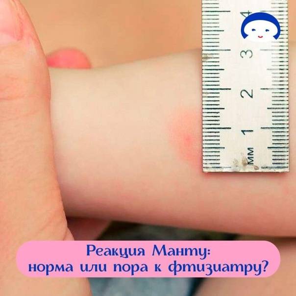 Как уменьшить отек манту