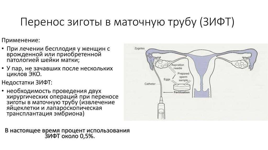 Бесплодие трубный фактор - программа эко при трубном бесплодии