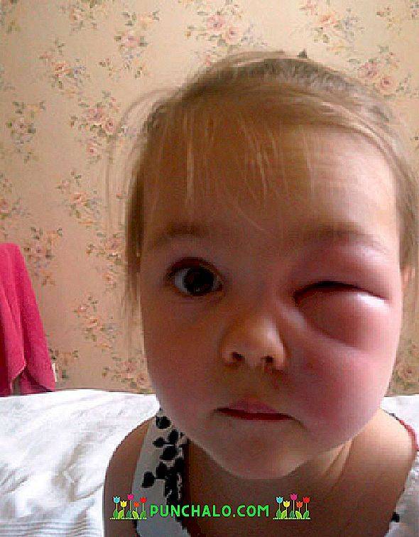 Что делать, если ребенка укусил комар или другое насекомое и весь глаз опух: как снять отек века после повреждения