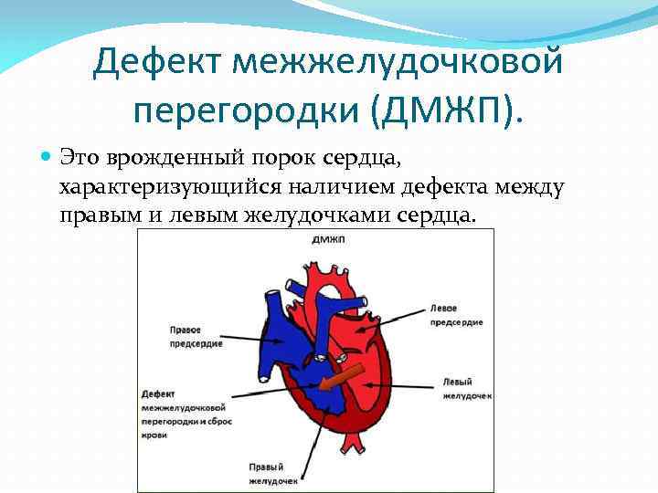 Дмжп у новорожденного: причины дефекта межжелудочковой перегородки, симптомы и лечение