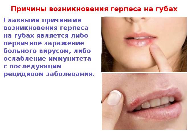 Герпес у детей: типы, симптомы, причины, лечение (препараты, народные средства, диагностика, профилактика), осложнения и последствия (фото, видео)